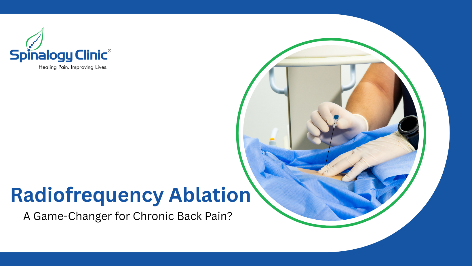 Radiofrequency Ablation: A Game-Changer for Chronic Back Pain?